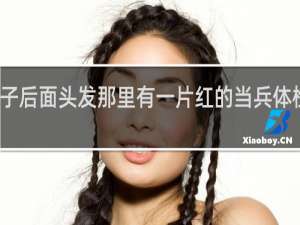 脖子后面头发那里有一片红的当兵体检能过吗