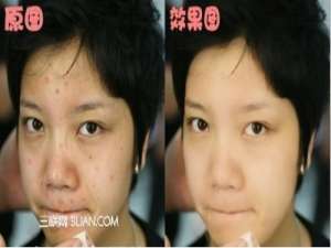 可牛祛痘新办法,四步呈现如玉肌肤