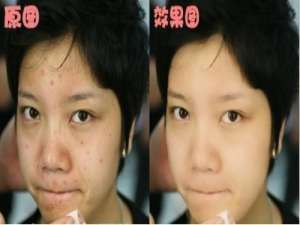 可牛影像祛痘新办法:4步呈现如玉肌肤