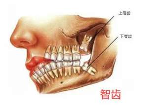 智齿是什么？智齿有必要拔吗？