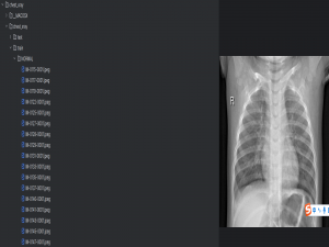 基于深度学习的胸部 X 光图像肺炎分类系统（七）